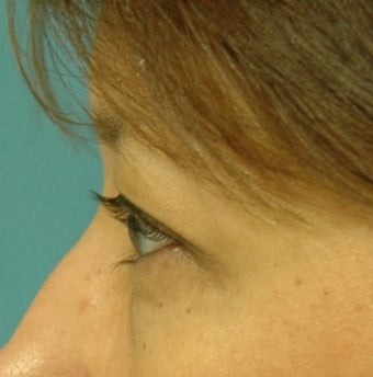 Upper Blepharoplasty before 125924