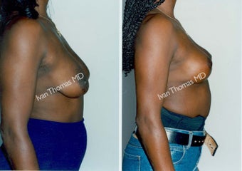 Mastopexy-Breast Lift before 243722