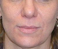 Volume Filler to Nasolabial Folds and Eye region after 52526