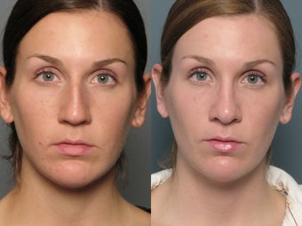 Nose Surgery before 338481