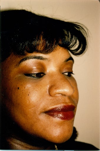 Rhinoplasty before 383009