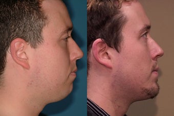 Chin Augmentation before 409093