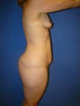 Tummy Tuck (Abdominoplasty),Breast Augmentation, Mommy Makeover, Liposuction 404209