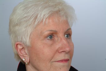Upper and lower Blepharoplasty after 321991