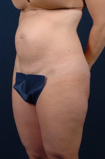 Abdominoplasty-Float before 267664