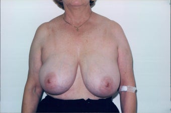 Breast Reduction before 218958