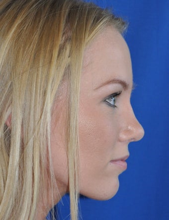 Rhinoplasty after 373784