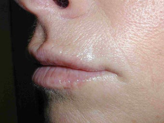 Restylane in Upper Lip after 108822