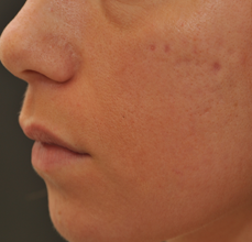 Acne Scarring before 426034