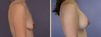 Breast Implants before 270010