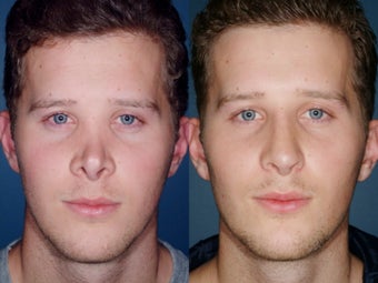 Revision rhinoplasty before 334244