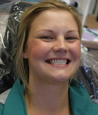 Upper arch make over with veneers and crowns 625407