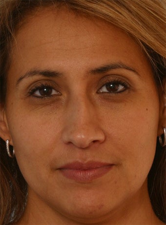 Non Surgical Rhinoplasty Juvederm Ultra Plus before 260327