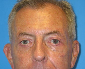 Upper and Lower Lid Blepharoplasty, Lower Lid Tarsal Strip after 147718