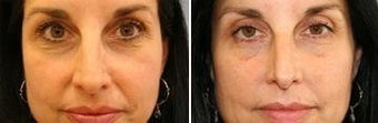 45 years old / two weeks post lower eye lid with fat transpositioning and Juvederm in nasolabial folds. before 343922