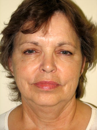 Natural Facelift and Necklift before 570610