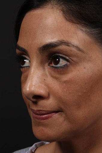 Facial fat grafting before 514131