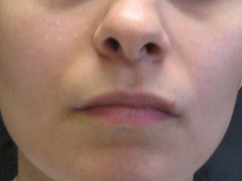 Sculptra injections before 272063