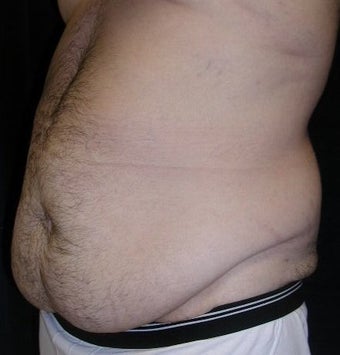 Male tummy Tuck 578190