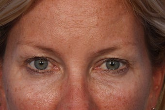 Restylane to Tear Trough (under eyes) after 308308
