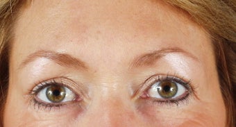 Endoscopic brow lift and blepharoplasty after 240871