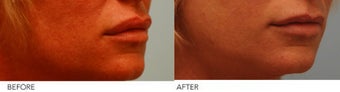 Lip Reduction before 254540