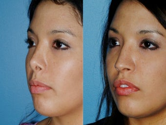 Revision rhinoplasty 395565