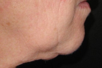 GentleYag treatment for skin tightening before 152215