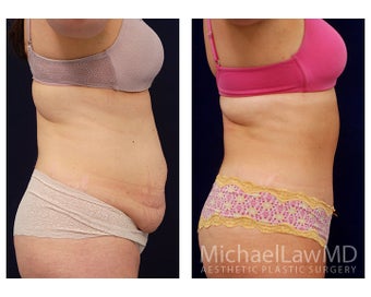 Tummy Tuck with Liposuction 391594