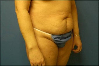 Abdominoplasty, Tummy Tuck, Liposuction 401748