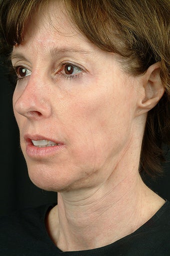 Fractional CO2 Laser before 531586