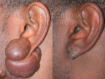 Keloid Removal before 615707