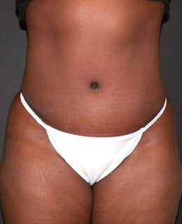Tummy Tuck with Flank Liposuction after 330902
