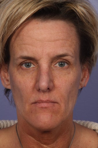 Botox before 333880
