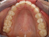 CEREC Restorations after 345561