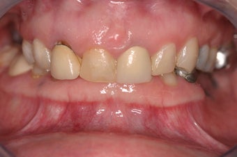 full mouth rehab before 340398