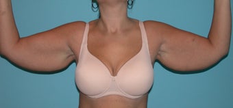Armlift before 287753