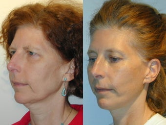 Full Facelift - Browlift, lower blepharoplasty, Lower Facelift after 137750