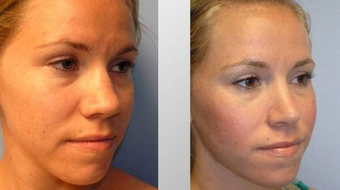 Rhinoplasty before 163631