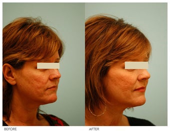 Acne Scarring Correction after 136801