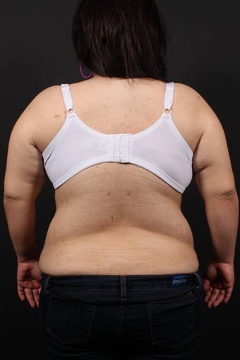 Bra Line Back Lift after 472813