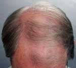 Hair Transplant before 426682