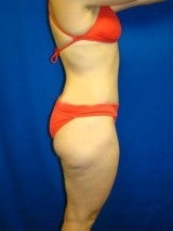 Breast Reduction, Tummy Tuck (Abdominoplasty), Mommy Makeover 404137
