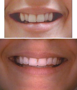 Invisalign before 109377