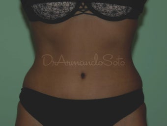 Abdominoplasty (Tummy Tuck) after 122891