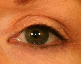 Upper Blepharoplasty (Upper Eyelids) 376859