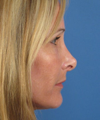 Revision Rhinoplasty 410807