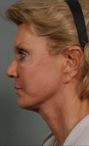 FaceLift after 269513