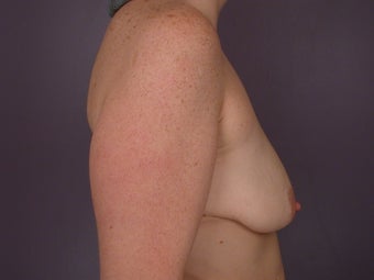 Breast Lift / Breast Augmentation before 291191