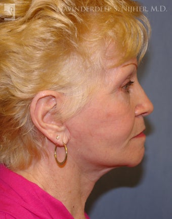 Facelift, Eyelid Surgery & Chin Implant after 501564